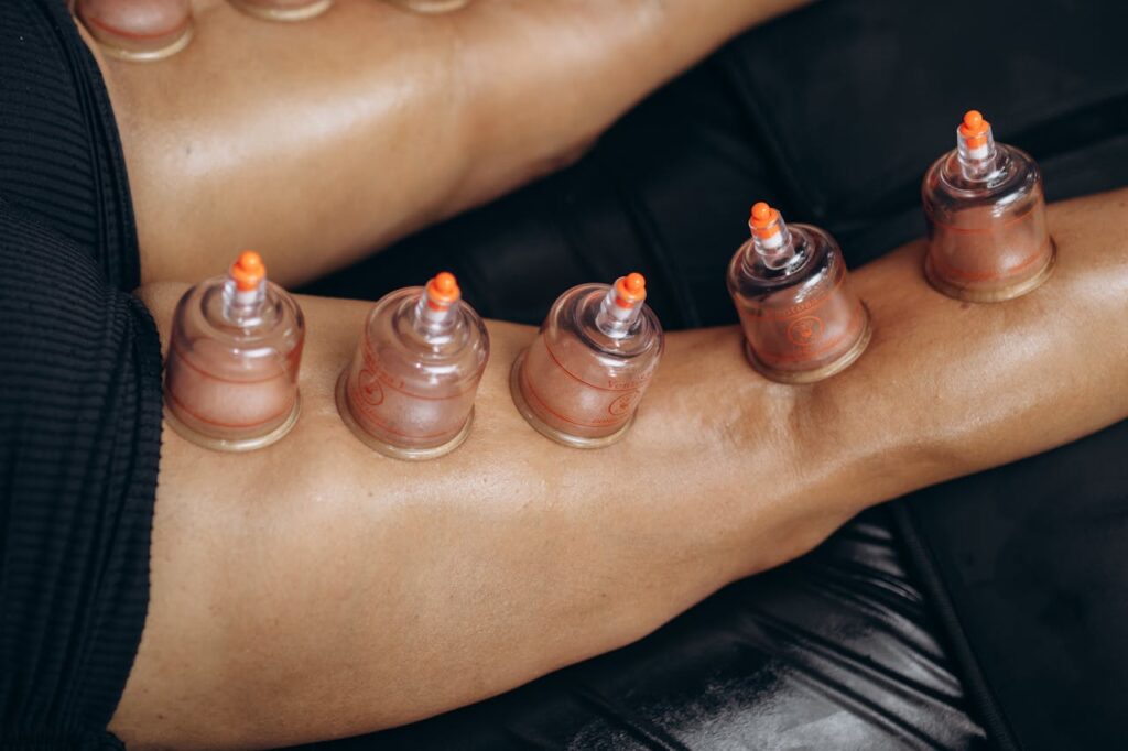 Close-up of cupping therapy on legs, highlighting natural healing and recovery benefits.